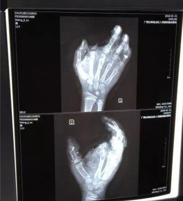 手機(jī)爆炸，12歲男孩手指被炸沒，寒假應(yīng)該注意哪些安全隱患